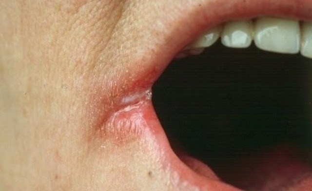 Penyebab Luka Di Sudut Bibir Dan Cara Menyembuhkannya Sipalas