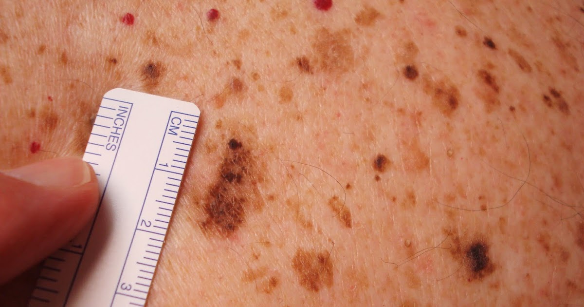 Virtual Grand Rounds In Dermatology 20 Atypical Melanocytic Lesions