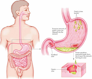 Penyakit Maag Cara Meningkatkan Nafsu Makan Penderita Maag