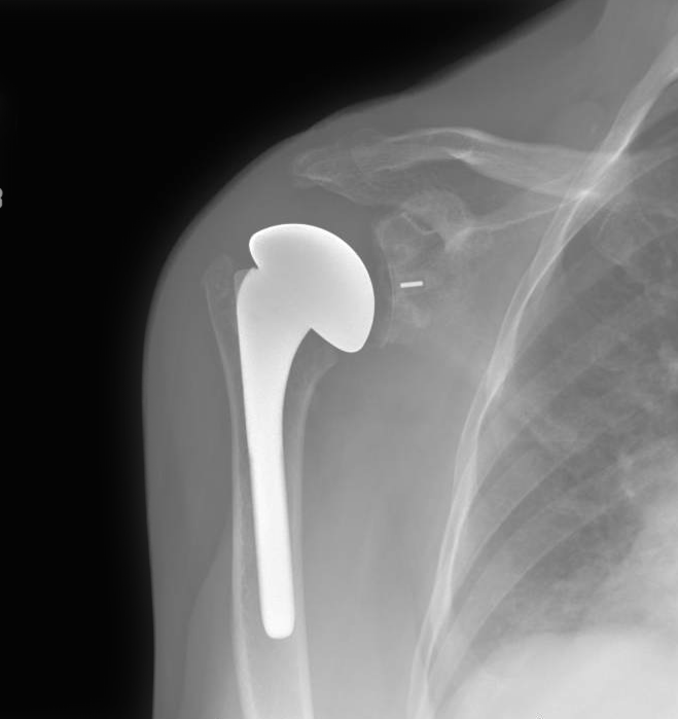 Shoulder and Elbow Surgery Subscapularis failure after anatomic total