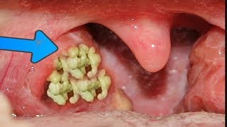3 Powerful Home Remedies for Tonsil Stones That Work Fast || Home Remedies To Remove Tonsil Stones  