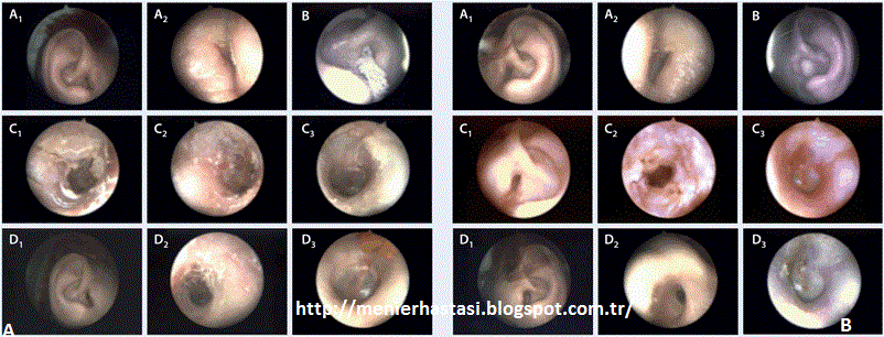 Menier Sendromu Dis Kulak 2