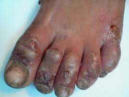 PENGOBATAN KADAS KUDIS KURAP JAMUR DAN EKSIM DENGAN SARAN DOKTER