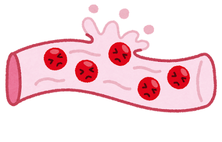 出血した血管のイラスト