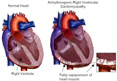 Arrhythmogenic Right Ventricular Cardiomyopathy (ARVC)