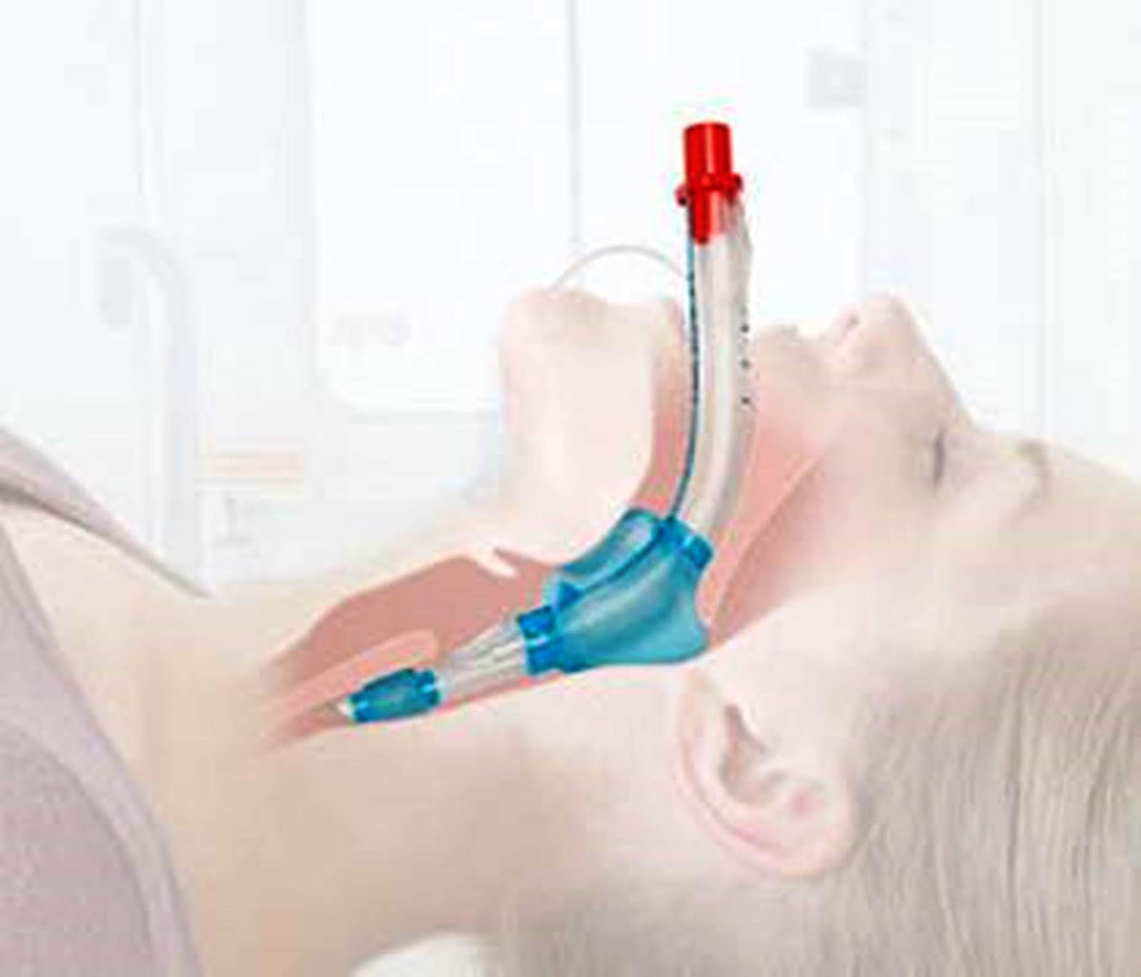 100030 воздуховод ларингеальный масочный lma classic (многоразовый, №3) (size 3). маска ларингеальная армированная. ларингеальный воздуховод. 5 (alba healthcare). воздуховод ларингеальный, одноразового использования.