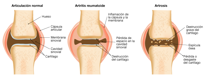 Artritis reumatoide y fibromialgia