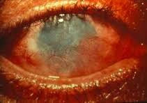 first aid chemical in eye الاسعافات الاولبة دخول مادة كيميائية الى العين