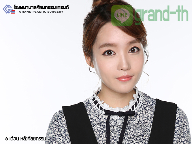 корейцы до и после пластики глаз. V line в корее. V line в корее. V line в корее. V-line пластика до и после.