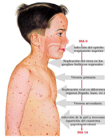 Photos Of Chicken Pox - How To Recognize The Rash | How To ...