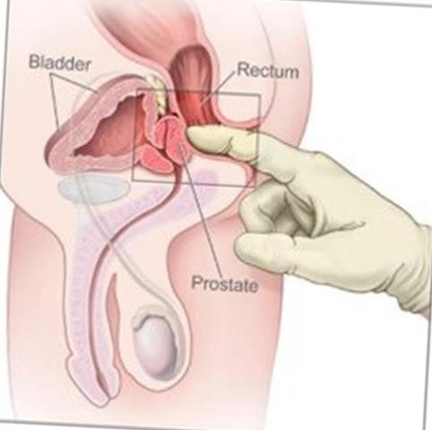 prostata si