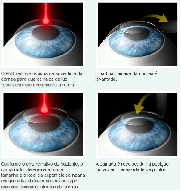 Ilustração de um passo-a-passo da operação a laser nos olhos : um primeiro laser remove tecidos da superfície da córnea, então outro laser é disparado nos olhos para que sejam feitas as correções necessárias.