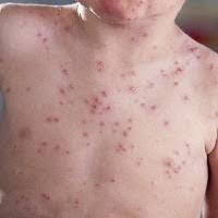 OBAT AMPUH ATASI GATAL BINTIK MERAH DI BAGIAN BADAN OBAT AMPUH ATASI GATAL BINTIK MERAH DI BAGIAN BADAN