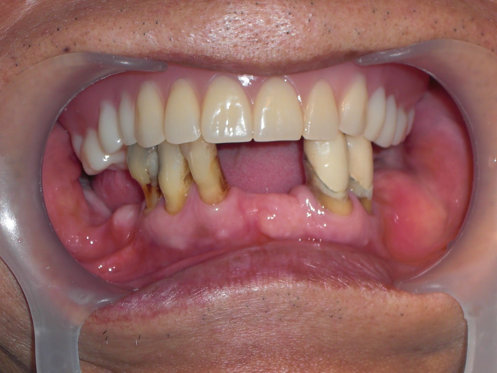 Dental Implantology: THE RESCUE OF A DENTAL CRIPPLE AND A LIFE TRANSFORMED