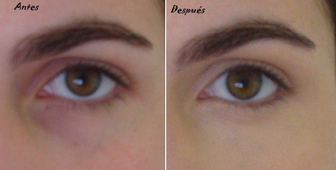 Eyelid Dermatitis Treatment and Symptoms - Seborrheic ...