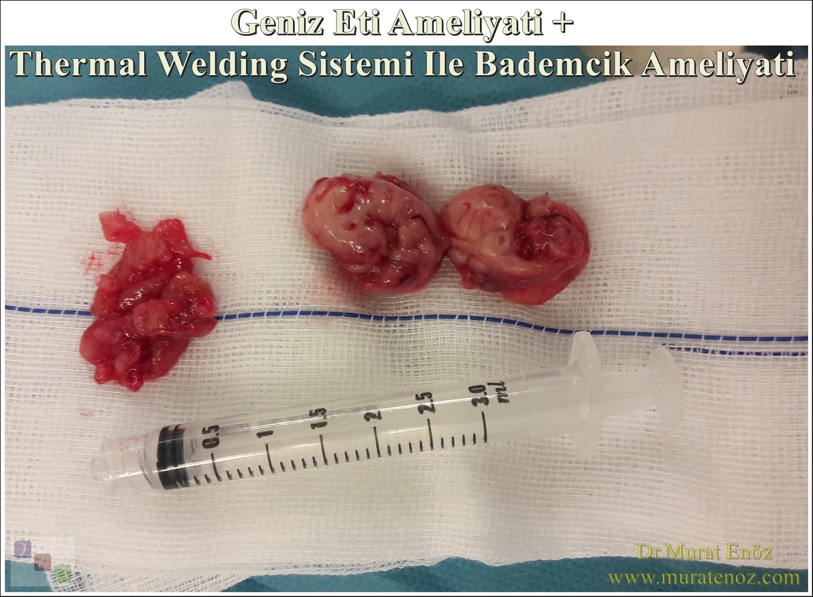 Thermal Welding Sistemi İle Bademcik Ameliyatı ve Klasik Geniz Eti