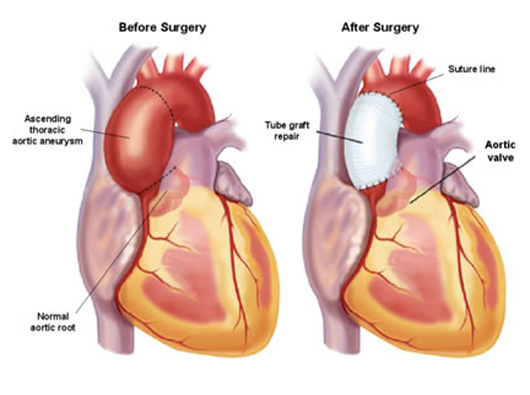 my aortic adventure may 2016 my aortic adventure may 2016