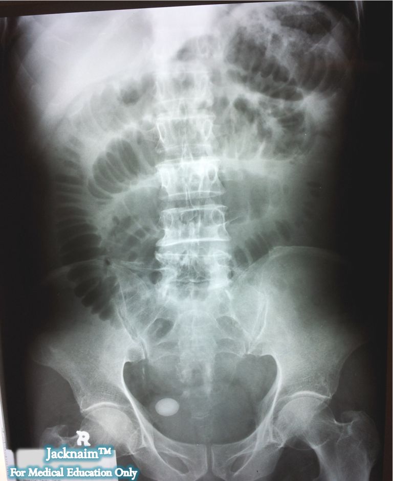 My Medical Notes Image of the Day 10 Acute Intestinal Obstruction