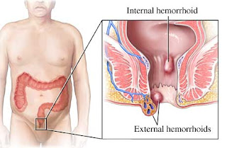 Cara Mengobati Ambeien Atau Wasir Dengan Air Hangat, Obat untuk penyakit Ambeien Di Dolok Marawa, Mengatasi Wasir Dengan Daun Sirsak, Jual Obat untuk penyakit Ambeien Di Lhoksukon, Obat Wasir Produk Nasa, Cara Alami mengobati penyakit Ambeien Stadium 2, Cara Membuat Obat Tradisional Untuk Ambeyen, Obat untuk penyakit Ambeien Untuk Menghentikan Pendarahan, Apakah Penyakit Ambeien Bisa Hilang, Obat buat penyakit Ambeien Di Subang, Jual Obat Wasir Di Pangkalpinang, Obat Wasir Bagi Wanita Hamil, Jual Obat buat penyakit Ambeien Di Pontianak, Obat Ambeien Atau Wasir Yang Paten, Ambeien Berdarah Olx, Obat penyakit Ambeien Di Tangerang Selatan, Pengobatan Ambeien Atau Wasir Di Jogja, Cara Cepat Mengobati Ambeyen Pada Ibu Hamil, Jual Obat untuk penyakit Ambeien Di Pulau Morotai, Obat penyakit Wasir Oles Untuk Ibu Hamil, Cara Mengobati Penyakit Wasir Dengan Alami, Obat Wasir Atau Ambeien Buat Orang Hamil, Obat buat penyakit Ambeien Dimasukkan, Obat Wasir Yang Cepat Sembuh, Kumpulan mengobati penyakit Ambeien Secara Alami, Obat untuk mengobati Wasir Dengan Lidah Buaya, Www.Obat untuk mengobati Wasir Herbal.Com, Apakah Penyakit Ambeyen Bisa Hilang, Mengobati Ambeyen Dengan Cuka Apel, Pengobatan penyakit Ambeien Dengan Suntikan 