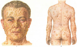 epidemics of smallpox