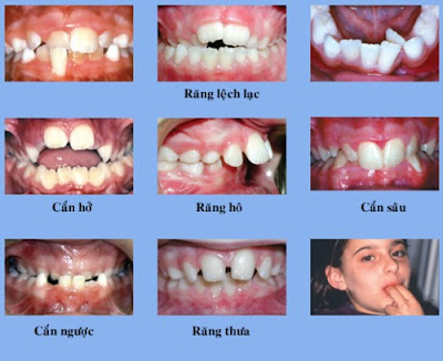 Răng vẩu có di truyền không? Giải đáp từ các chuyên gia Răng vẩu có di truyền không? Giải đáp từ các chuyên gia