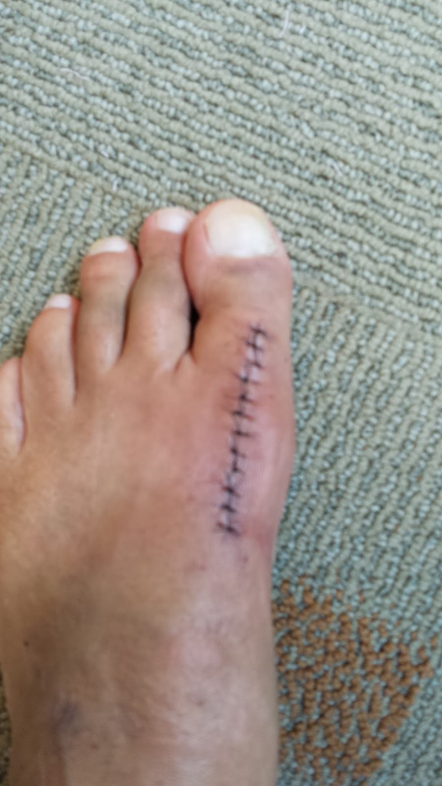 My Cheilectomy Journal September 2015