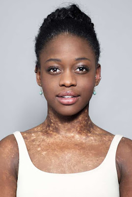 Michaela Deprince nació con Vitiligo