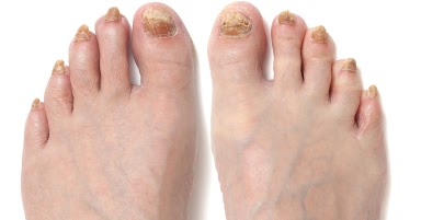 Si los pies se descaman las uñas el hongo
