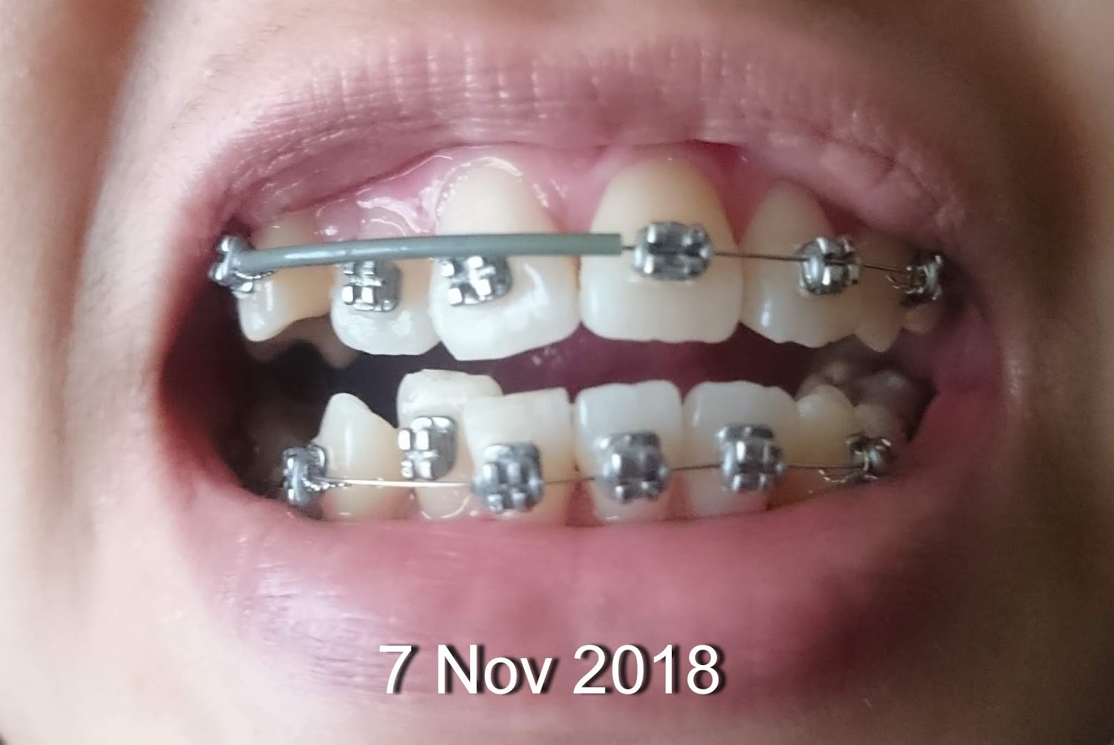 nanyfadhly Braces Story Updated! Part 4