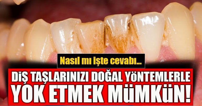 Diş Taşları Doğal Yollarla Nasıl Temizlenir