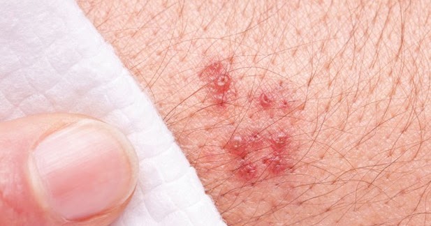 Natural Remedies For Pimples Under The Skin Natural Remedies For Pimples Under The Skin
