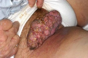 Wart - Wikipedia