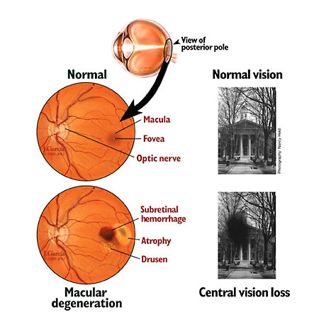 Macular Degeneration