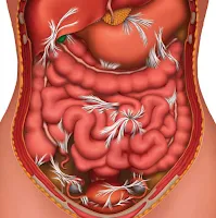 Endometriosis dan adhesi atau perlengketan