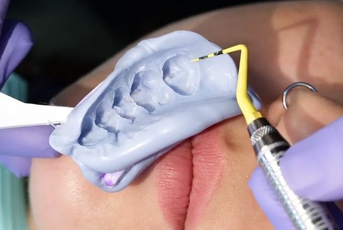 PROSTHODONTICS: Single-Unit Crown Workflow Solutions™ Procedure - Posterior Restoration