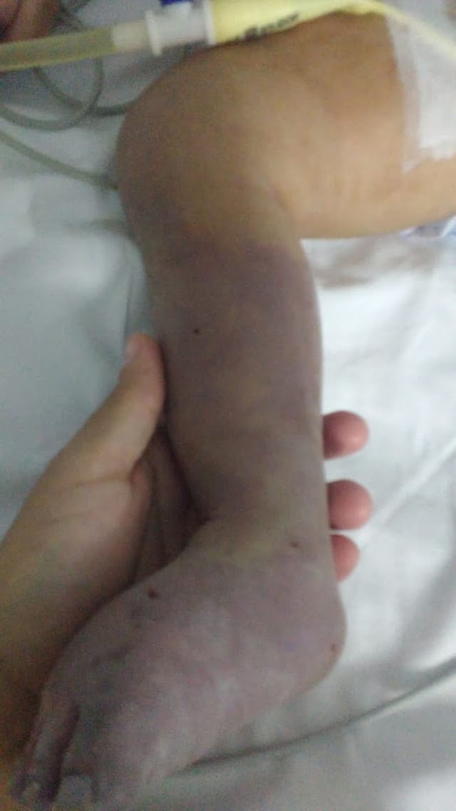 Bebê tem perna amputada após procedimento em hospital 