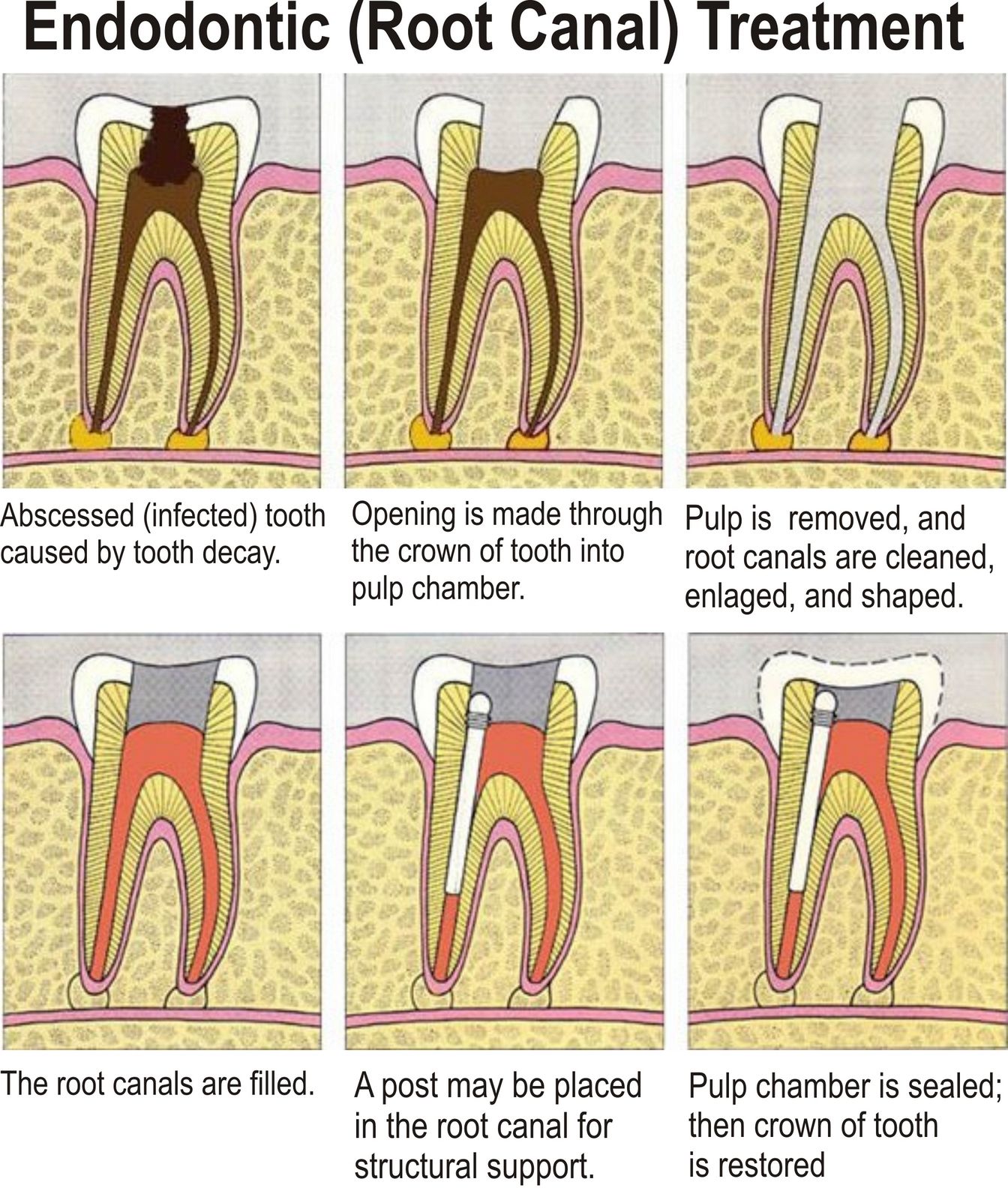 Precautions after root canal treatment