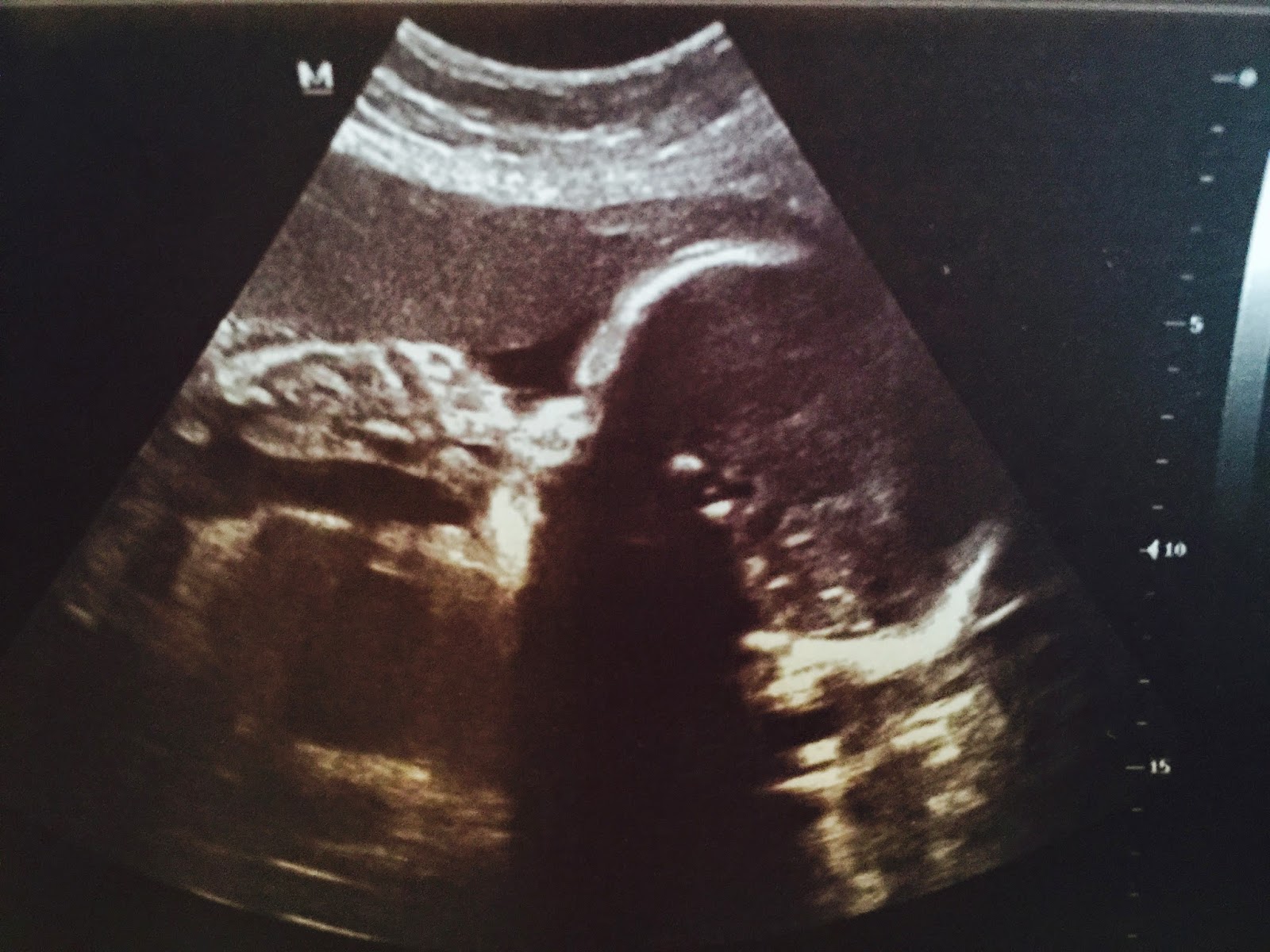 Gloria in Excelsis Deo: 30-week Ultrasound