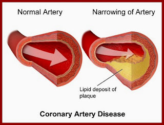 cholesterol plaque buildup in an artery