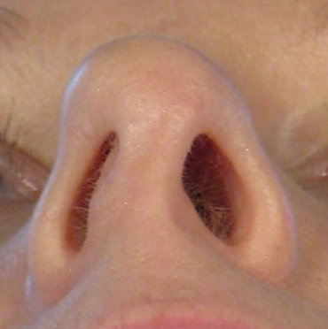 Why Is a Nosejob Sometimes Necessary to Resolve Nasal Obstruction
