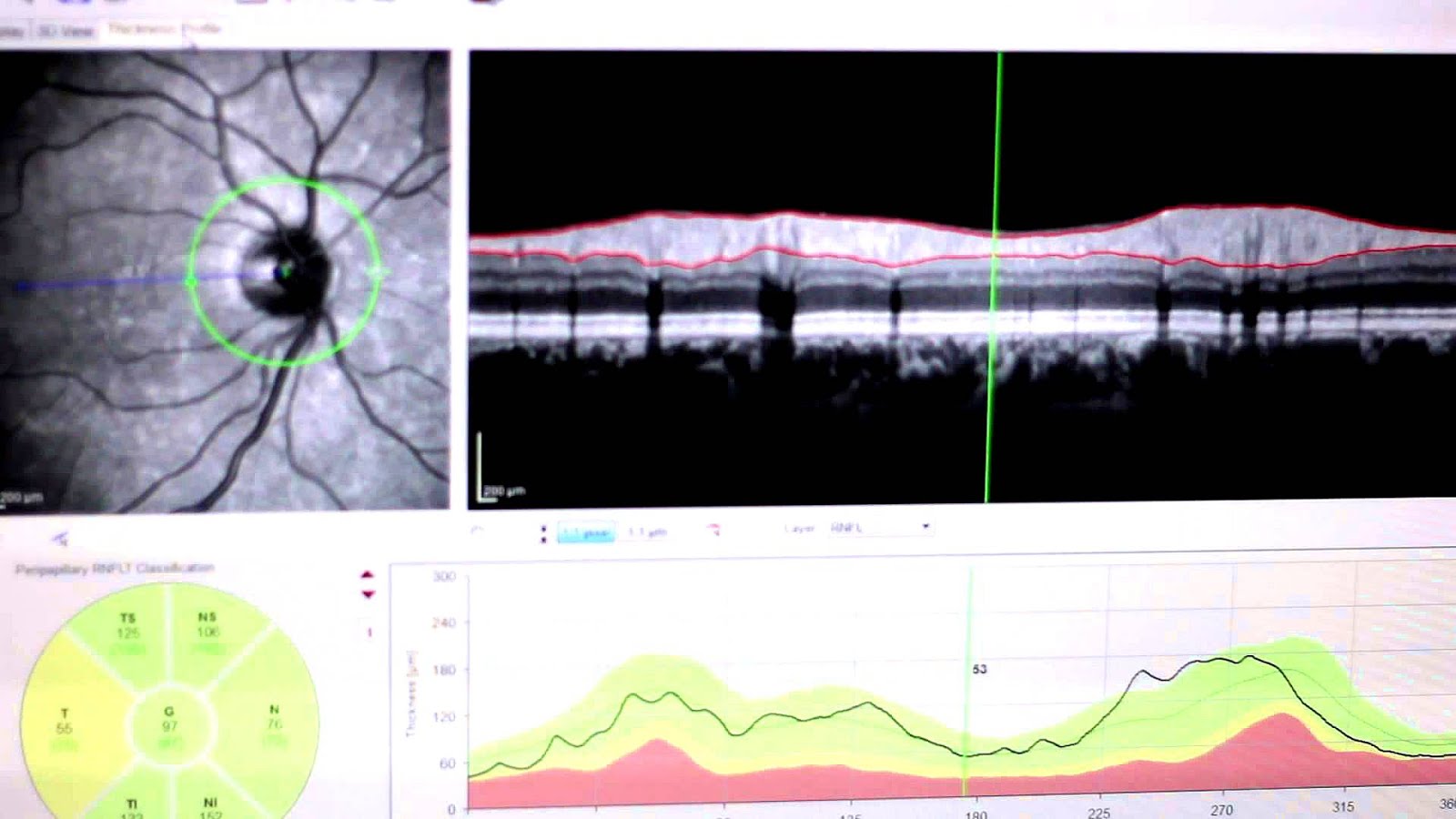 Best Contact Brand For Dry Eyes Brand Choices