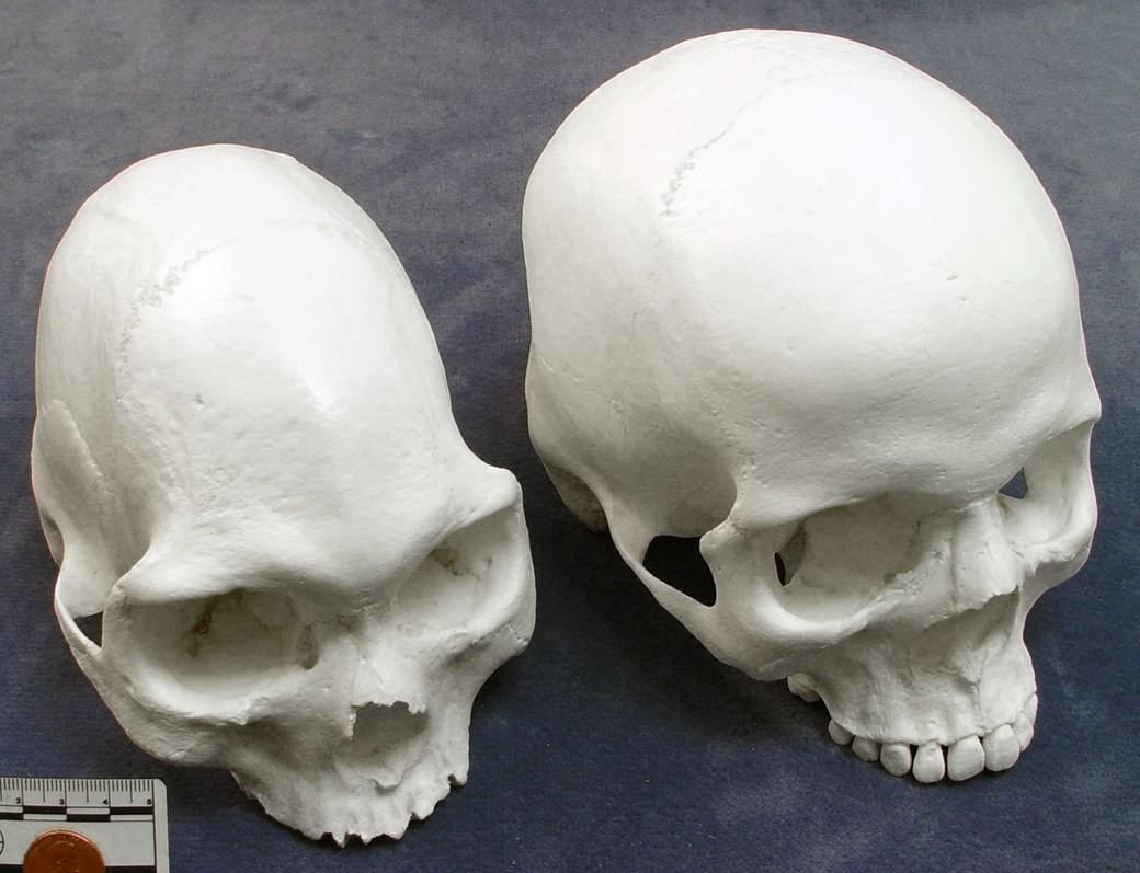Варианты формы черепа. Форма черепа. Нестандартная форма черепа.