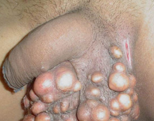 Blue Waffle Sexually Transmitted Disease Pictures Blue Waffle Sexually Transmitted Disease Pictures