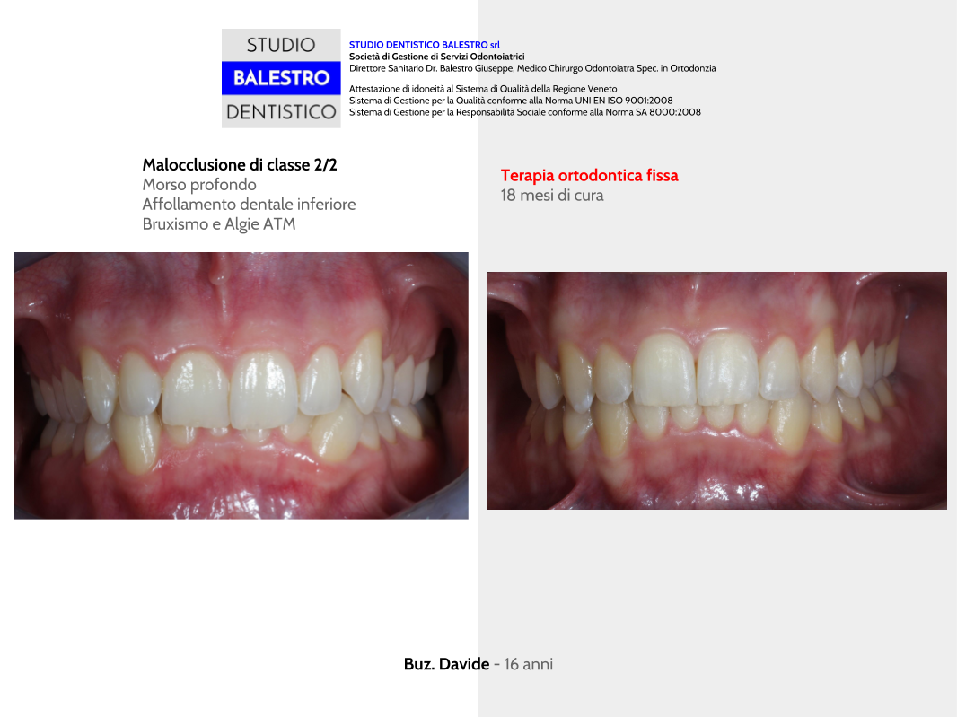 Modello Con Vallo Di Occlusione In Resina | GF Dental - Foto 7