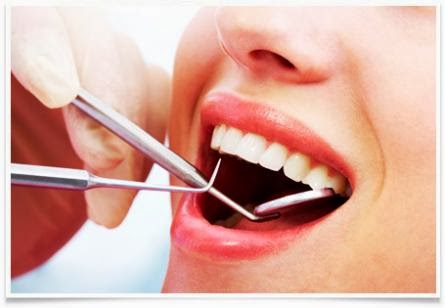 Untuk kali ini blog kesehatan akan mencoba membahas mengenai  Tips Cara Menghilangkan Karang Gigi Secara Alami