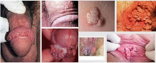 Obat Kutil Kelamin Di Apotik Umum Paling Ampuh Saran Dokter Kelamin Obat Kutil Kelamin Di Apotik Umum Paling Ampuh Saran Dokter Kelamin