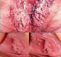 Kapsul Dan Salep Obat Kutil Kelamin Yang Ampuh Sembuhkan Kutil Di Vagina Kapsul Dan Salep Obat Kutil Kelamin Yang Ampuh Sembuhkan Kutil Di Vagina