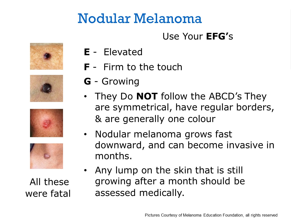 Just found out i have nodular melanoma and scared to death ...