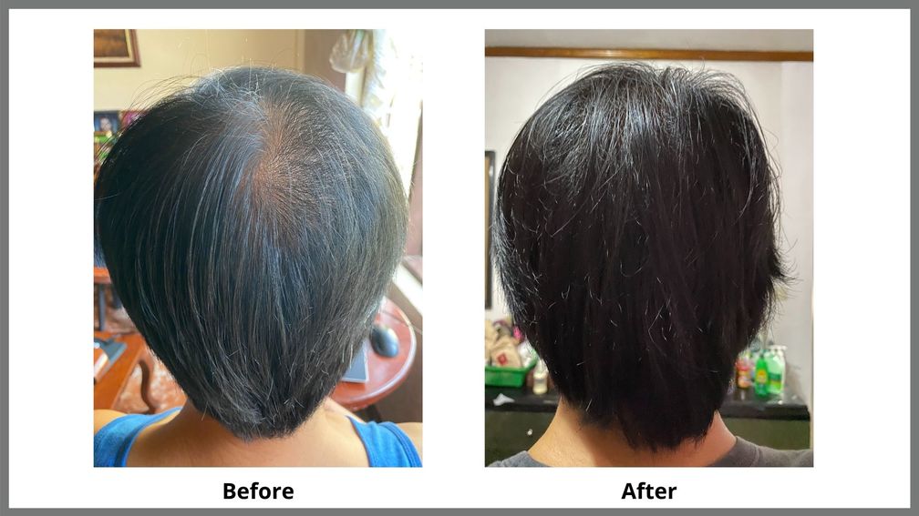 A comparative before and after photo when I used Medic Hair on my scalp.