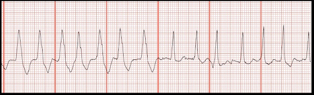 Practice EKG Rhythm Strips 103